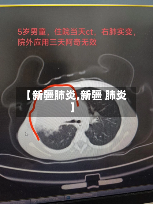 【新疆肺炎,新疆 肺炎】-第2张图片
