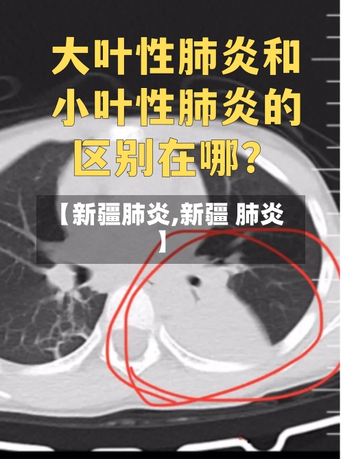 【新疆肺炎,新疆 肺炎】-第3张图片