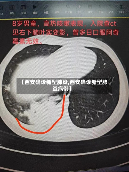【西安确诊新型肺炎,西安确诊新型肺炎病例】