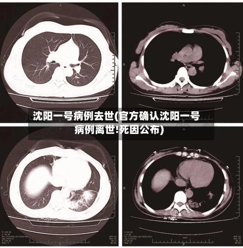 沈阳一号病例去世(官方确认沈阳一号病例离世!死因公布)
