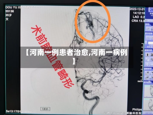 【河南一例患者治愈,河南一病例】-第3张图片